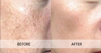 MICRONEEDLING WITH BIOREPEEL CL3