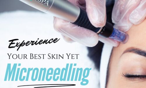 5 Ways Microneedling Can Transform Your Skin in Naples